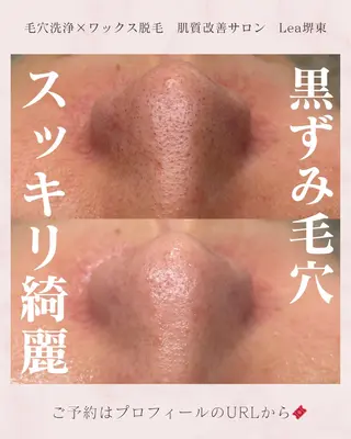 Lea堺東　毛穴洗浄 ×顔ワックス脱毛のその他イメージ