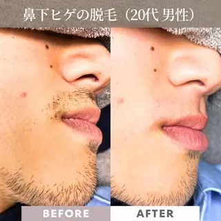 メンズ 【一本ずつ脱毛】 ReMove 柏のエステ・リラクイメージ