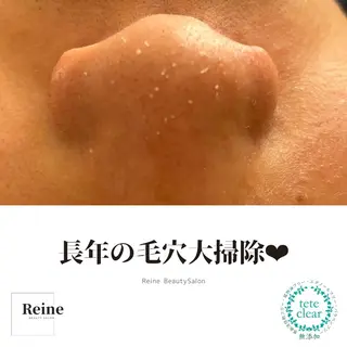 毛穴/シミ肝斑/脱毛 横山梨里のエステ・リラクイメージ