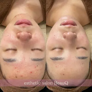 肌質改善/ブライダル 水上百華のエステ・リラクイメージ