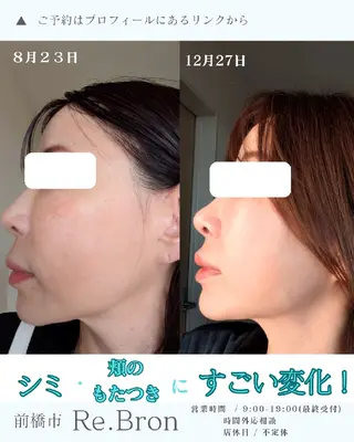 毛穴ケア くすみ肌 ハーブピーリングのエステ・リラクイメージ