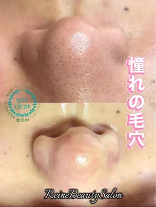 毛穴/シミ肝斑/脱毛 横山梨里のエステ・リラクイメージ