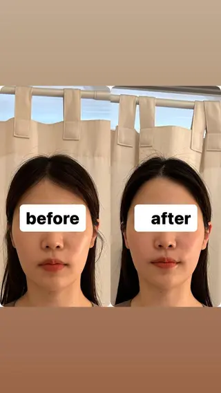 美容鍼WINBACK サロンRemeのエステ・リラクイメージ