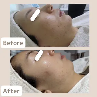 メンズ 〈ニキビケアサロン〉 レゾン京橋店/ 浅川のエステ・リラクイメージ