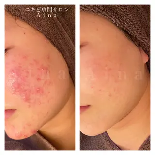 セミロング パーマ ヘアアレンジ メンズ キッズ ネイル マツエク・マツパ アイブロウ ニキビ跡専門サロン Ainaのエステ・リラクイメージ