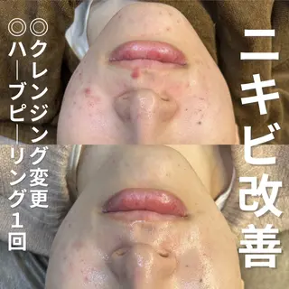 ニキビ・ニキビ跡改善 leoloのエステ・リラクイメージ
