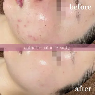 肌質改善/ブライダル 水上百華のエステ・リラクイメージ