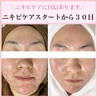 ニキビ・ 肌荒れ専門店のエステ・リラクイメージ