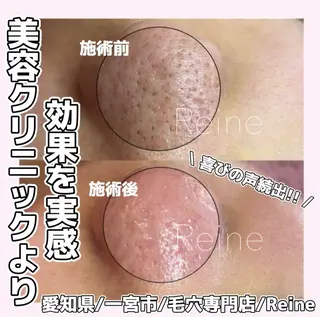 毛穴/シミ肝斑/脱毛 横山梨里のエステ・リラクイメージ