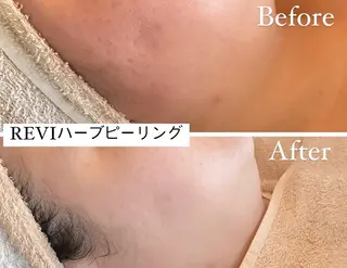 🌿ハーブピーリング ・脱毛◆Refreのエステ・リラクイメージ