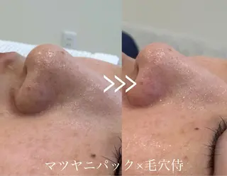 毛穴開き黒ずみ ニキビ特化💆‍♀️のエステ・リラクイメージ