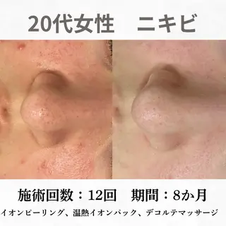 重度ニキビ専門🌷 ダウンタイムなしのエステ・リラクイメージ