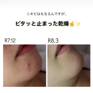 ニキビ/敏感肌/乾燥 Lilyauraのエステ・リラクイメージ