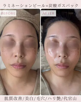 【ハーブピーリング/韓国ツヤ肌ピーリング】RelierBelle-ルリエベル-所属・肌質改善/肌育特化 プライベートサロンのエステ・リラクイメージ