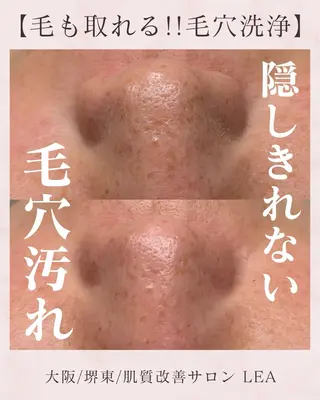 Lea堺東　毛穴洗浄 ×顔ワックス脱毛のその他イメージ