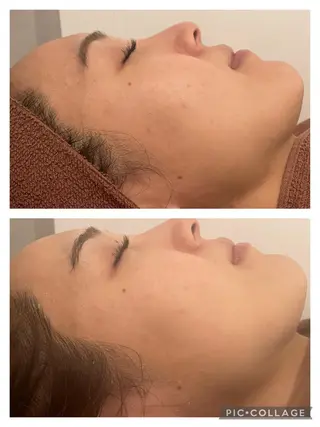 セミロング カラー パーマ ヘアアレンジ メンズ キッズ ネイル マツエク・マツパ アイブロウ 3か月で肌革命👼 ニキビ専門店💫のエステ・リラクイメージ