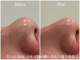 毛穴開き黒ずみ ニキビ特化💆‍♀️のエステ・リラクイメージ