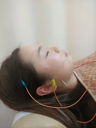 リフトアップ・たるみ ☆美容鍼小顔矯正のその他イメージ