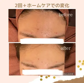 3か月で肌革命👼 ニキビ専門店💫のエステ・リラクイメージ