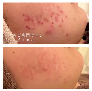 ショート カラー パーマ ヘアアレンジ メンズ キッズ ネイル マツエク・マツパ アイブロウ ニキビ跡専門サロン Ainaのエステ・リラクイメージ