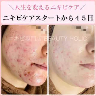 ニキビ・ 肌荒れ専門店のエステ・リラクイメージ