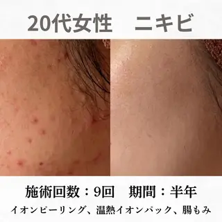 重度ニキビ専門🌷 ダウンタイムなしのエステ・リラクイメージ