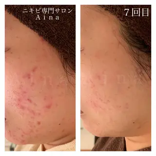 ロング カラー パーマ ヘアアレンジ メンズ キッズ ネイル マツエク・マツパ ニキビ跡専門サロン Ainaのエステ・リラクイメージ