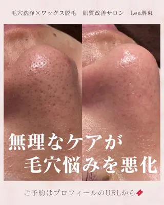 Lea堺東　毛穴洗浄 ×顔ワックス脱毛のその他イメージ
