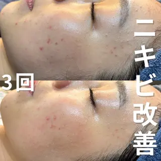 ニキビ・ニキビ跡改善 leoloのエステ・リラクイメージ