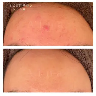 セミロング パーマ ヘアアレンジ メンズ キッズ ネイル マツエク・マツパ アイブロウ ニキビ跡専門サロン Ainaのエステ・リラクイメージ