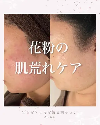 ロング パーマ ヘアアレンジ メンズ キッズ ネイル マツエク・マツパ アイブロウ ニキビ跡専門サロン Ainaのエステ・リラクイメージ