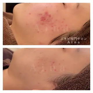 ロング カラー パーマ ヘアアレンジ メンズ キッズ ネイル マツエク・マツパ アイブロウ ニキビ跡専門サロン Ainaのエステ・リラクイメージ