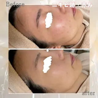 ニキビ&跡改善サロン オーナー光木のエステ・リラクイメージ