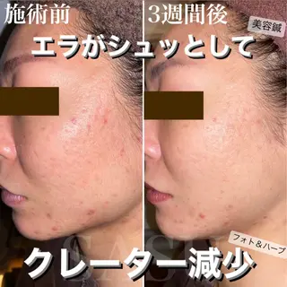 メンズ キッズ アイブロウ 即小顔♥️美容鍼× ハーブピーリングのその他イメージ