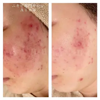 セミロング カラー パーマ ヘアアレンジ メンズ キッズ ネイル マツエク・マツパ アイブロウ ニキビ跡専門サロン Ainaのエステ・リラクイメージ