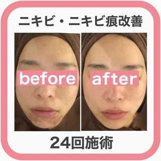 セミロング カラー パーマ ヘアアレンジ メンズ キッズ ネイル マツエク・マツパ アイブロウ 3か月で肌革命👼 ニキビ専門店💫のエステ・リラクイメージ