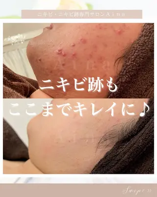 セミロング ヘアアレンジ メンズ キッズ ネイル マツエク・マツパ アイブロウ ニキビ跡専門サロン Ainaのエステ・リラクイメージ