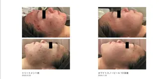 ピーリングケア 🤍moekoのその他イメージ