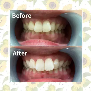 セルフホワイトニング 『Luster』のその他イメージ