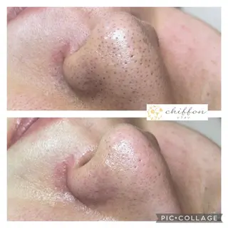 毛穴黒ずみ改善🥇 ✨シフォン豊田✨のエステ・リラクイメージ