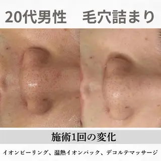 重度ニキビ専門🌷 ダウンタイムなしのエステ・リラクイメージ