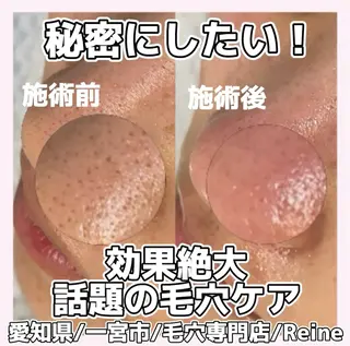 毛穴/シミ肝斑/脱毛 横山梨里のエステ・リラクイメージ