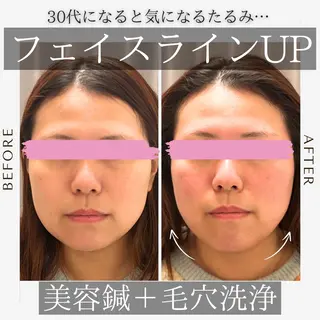《美肌･小顔》美容鍼 ＆マッサージ＊MEIのエステ・リラクイメージ