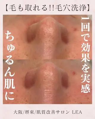 Lea堺東　毛穴洗浄 ×顔ワックス脱毛のその他イメージ