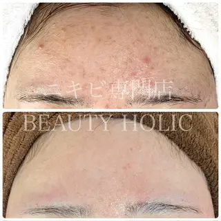 ニキビ・ 肌荒れ専門店のエステ・リラクイメージ