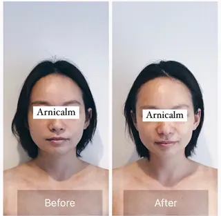 ハーブピーリング 肌再生ピーリング/のエステ・リラクイメージ