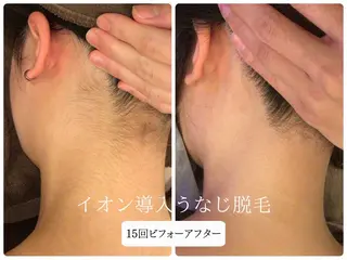 🎀うなじ脱毛🎀 ㅣLino堀江のエステ・リラクイメージ