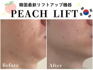 韓国肌管理🇰🇷 水光肌/肌質改善🫧のエステ・リラクイメージ