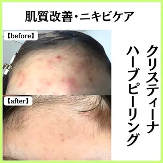 小顔ハーブピーリング 美容鍼/毛穴洗浄のエステ・リラクイメージ