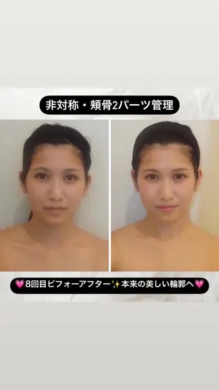 整形級の変化👀 最新✨韓国小顔管理のエステ・リラクイメージ